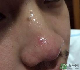 wis去黑头套装多少钱?wis去黑头套装价格