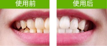 牙贴怎么分上下牙贴？牙贴怎么分正反