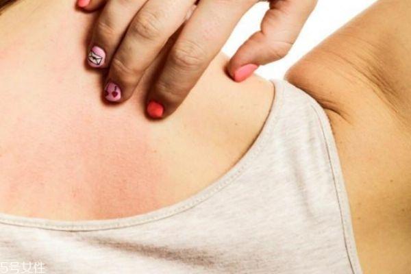 如何消除背部的痘痘 4招让你告别背上的痘痘