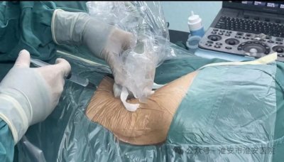 ​我院泌尿外科马宝杰博士团队成功开展局麻下经皮肾镜碎石术