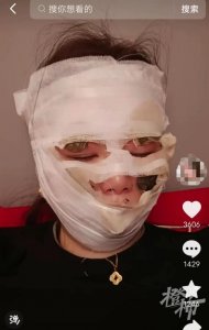 ​婚礼当天，新娘脸部被严重烫伤！罪魁祸首竟是这个气氛道具→