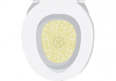 ​你知道蛋白尿是什么吗？你的尿液含有蛋白质的征兆是什么？