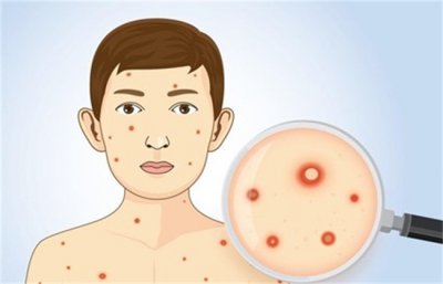 ​水痘带状疱疹病毒的传播途径 都有哪些