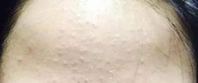 ​怎么消额头闭合性粉刺(额头长闭合性粉刺怎么消除)